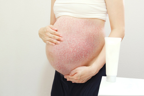 Phụ nữ mang thai có nên dùng thuốc chống dị ứng