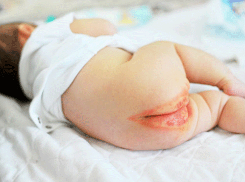 Hình ảnh dị ứng bỉm ở trẻ nặng do mẹ nhầm lẫn với bệnh ngoài da