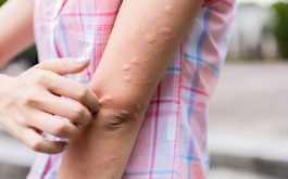 Nổi Mề Đay Ở Tay: Triệu Chứng Và Hướng Điều Trị Hiệu Quả