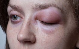Nổi Mề Đay Sưng Mí Mắt: Dấu Hiệu Cảnh Báo Phù Mạch Nguy Hiểm
