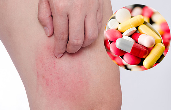 Hình Ảnh Các Dạng Bệnh Nổi Mề Đay Thường Gặp