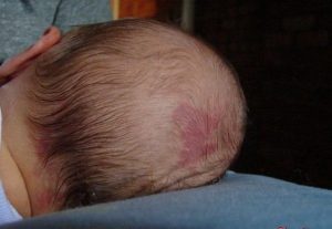 Trẻ sơ sinh bị nổi mẩn đỏ ở đầu