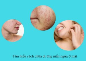 Cách chữa dị ứng mẩn ngứa ở mặt