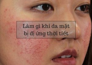 làm gì khi da mặt bị dị ứng thời tuế