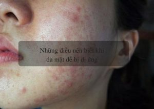 điều bạn nên biết khi da mặt dễ bị dị ứng 