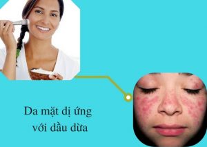 cách xử lý khi da mặt dị ứng với dầu dừa