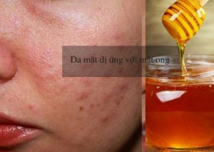 da mặt dị ứng với mật ong