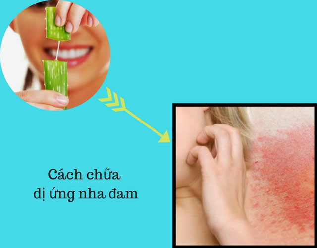 Cách chữa dị ứng nha đam đơn giản