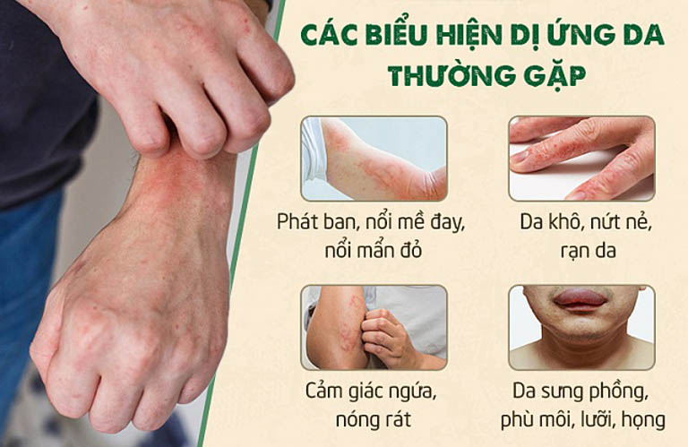 Dị ứng da có thể trở thành mãn tính