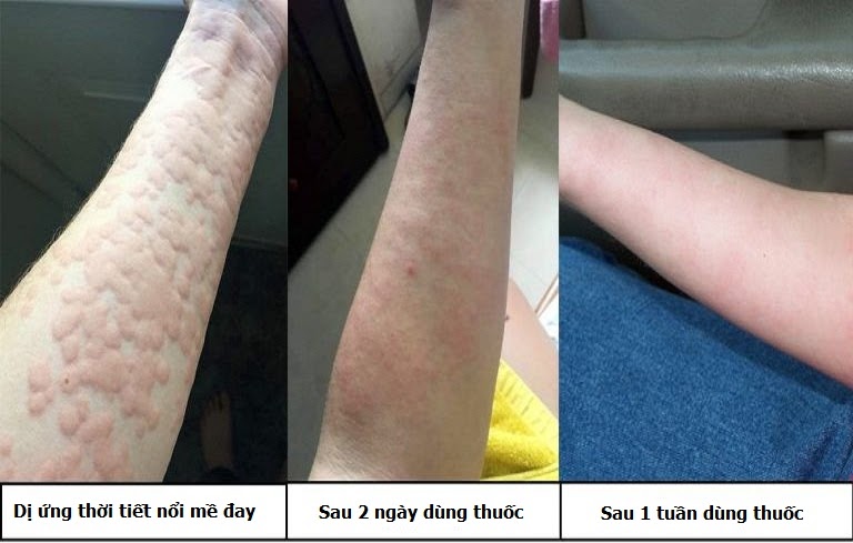 Hiệu quả trước và sau dùng thuốc Tiêu ban Giải độc thang