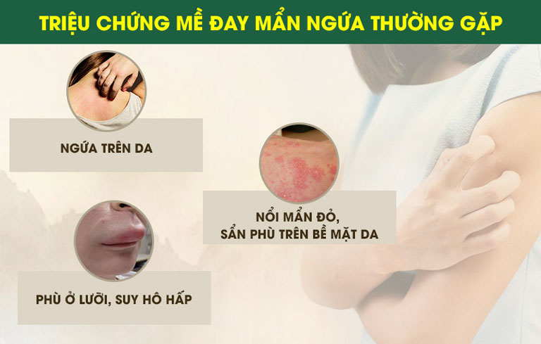 Hình ảnh nổi mề đay mẩn ngứa