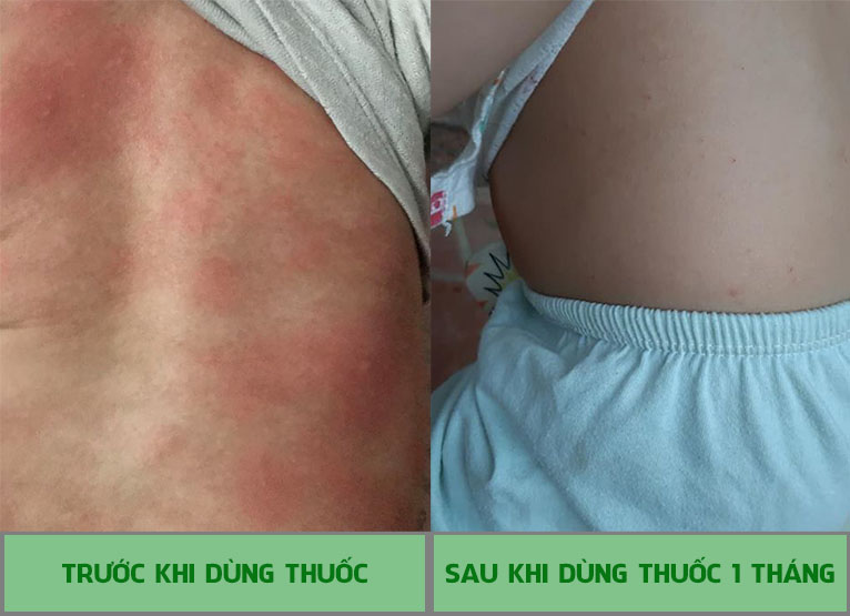 nổi mề đay ở trẻ em