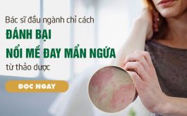 Bác sĩ da liễu chỉ cách thoát mề đay mẩn ngứa bằng dược liệu tự nhiên