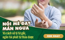 Bài thuốc Nam đánh bại mề đay mẩn ngứa hiệu quả đến 95%