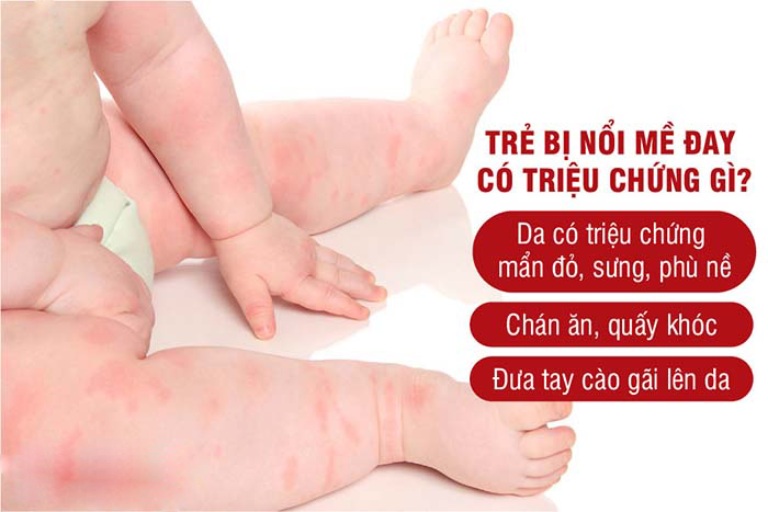 Biểu hiện nổi mề đay ở trẻ em