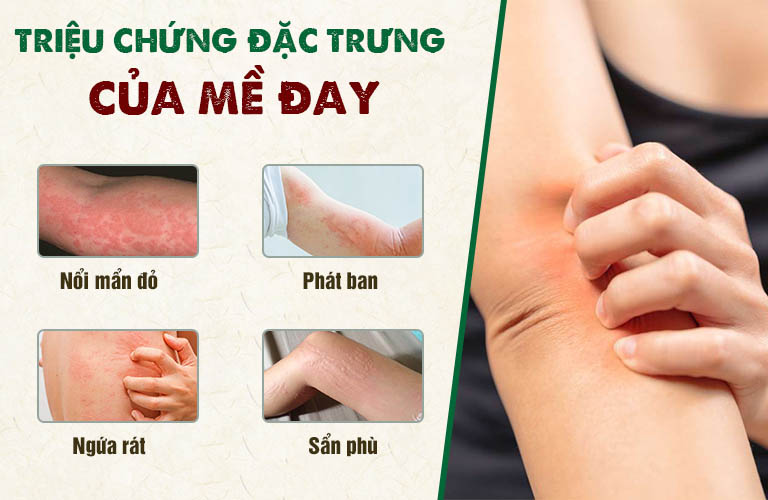 Triệu chứng mề đay thường gặp