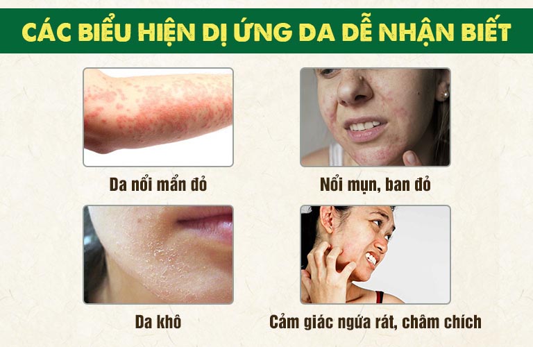 Biểu hiện dị ứng da