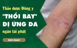 Giải mã liệu pháp đanh bay dị ứng da từ thảo dược của TT Thuốc dân tộc