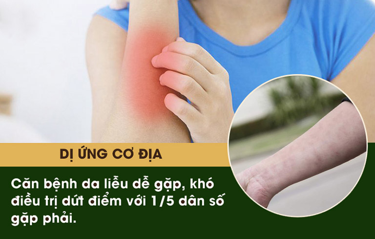 Dị ứng cơ địa có thể gây ra các triệu chứng nguy hiểm đến sức khỏe