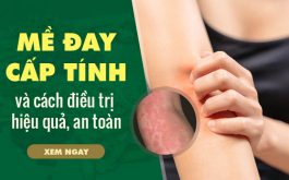 Mề đay cấp tính: Dấu hiệu nhận biết và cách điều trị hiệu quả, an toàn