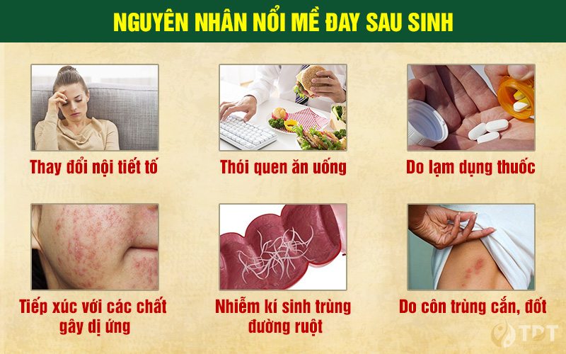 Nguyên nhân nổi mề đay sau sinh