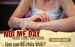 Nổi mề đay mãn tính: Làm sao để chữa khỏi bệnh hoàn toàn?