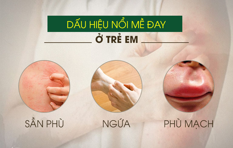 Biểu hiện mề đay ở trẻ em