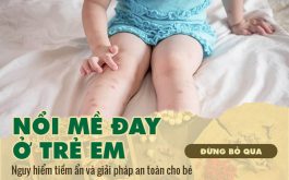 Nổi mề đay ở trẻ em: Nguy hiểm tiềm ấn nếu không chữa đúng cách