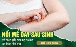 Nổi mề đay sau sinh - Làm sao giải cứu làn da cho mẹ? "