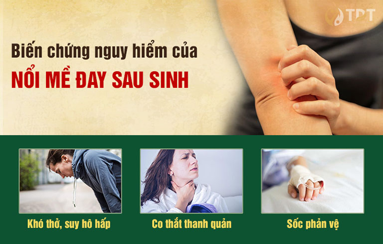 Nổi mề đay sau sinh gây nguy hiểm cho sức khỏe người mẹ