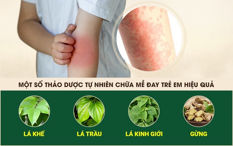 Nổi mề đay ở trẻ em