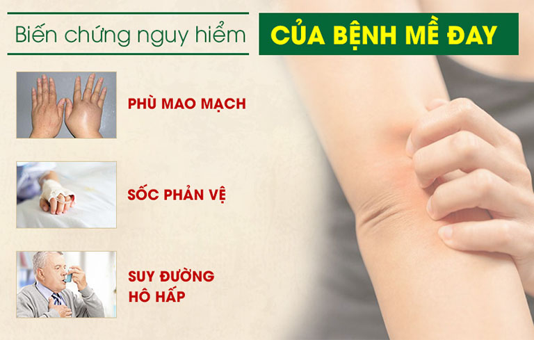 Những biến chứng nguy hiểm của mề đay mãn tính