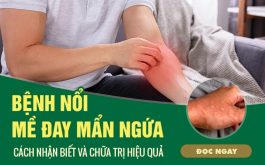 Nổi mề đay mẩn ngứa và cách điều trị dưới góc nhìn của chuyên gia da liễu