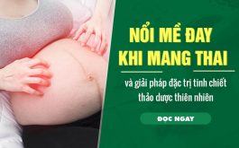 8 thảo dược quý chữa mề đay khi mang thai nổi tiếng lành tính ban nên biết