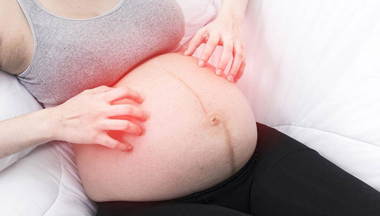 Tiêu ban Giải độc thang chữa mề đay khi mang thai