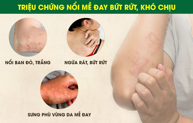 Một số triệu chứng nổi mề đay