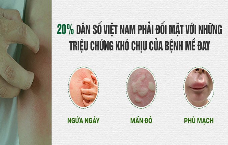 Bài thuốc điều trị mề đay Tiêu ban Giải độc thang