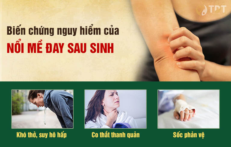 Mề đay sau sinh tiềm ẩn nhiều biến chứng nguy hiểm