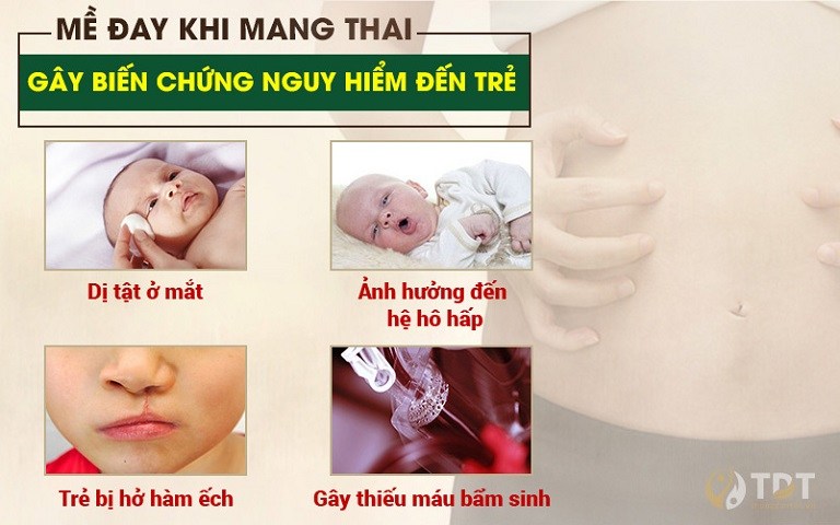 Trung tâm Thuốc dân tộc chữa mề đay