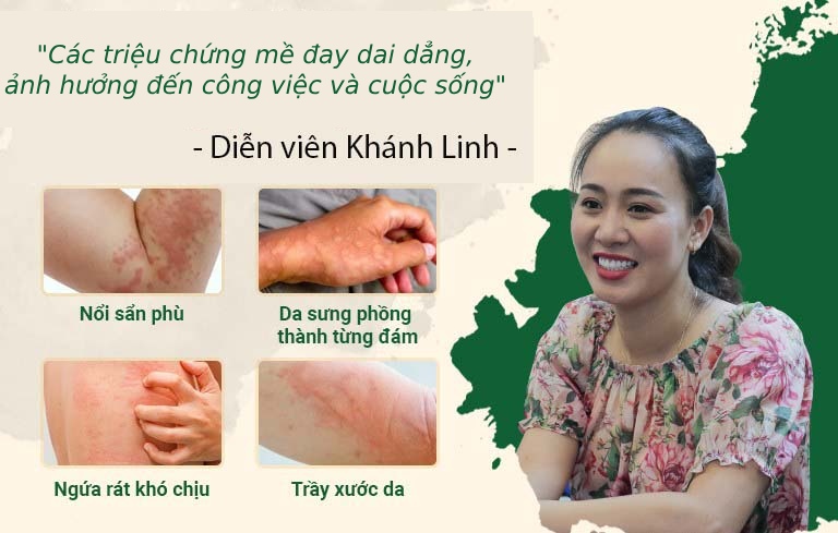 Các triệu chứng mề đay khó chịu