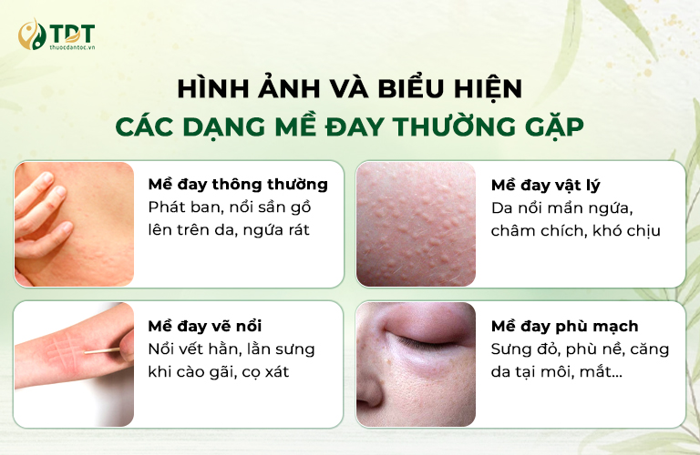 Các dạng mề đay thường gặp