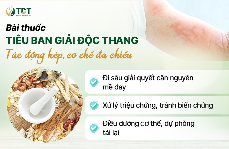 Cơ chế hỗ trợ điều trị mề đay toàn diện