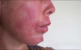 Nổi Mề Đay Ở Mặt: Triệu Chứng Và Cách Điều Trị Hiệu Quả