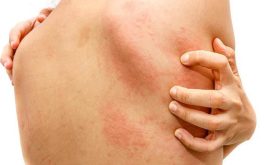 Vì Sao Nổi Mề Đay Khi Trời Lạnh? Chuyên Gia Tư Vấn Cách Chữa Hiệu Quả
