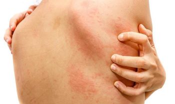 Vì Sao Nổi Mề Đay Khi Trời Lạnh? Chuyên Gia Tư Vấn Cách Chữa Hiệu Quả