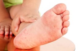 Nguyên Nhân Nổi Mề Đay Ở Chân Và Cách Điều Trị Hiệu Quả Cao