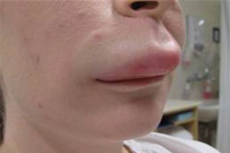 Nổi mề đay sưng môi